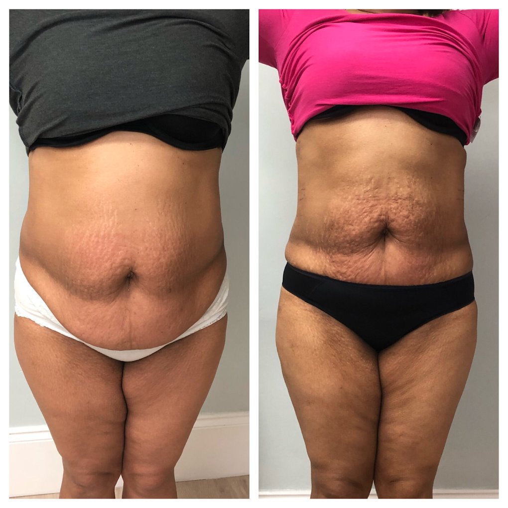 A client's tummy from the front, before and after LipoFirm body contouring
