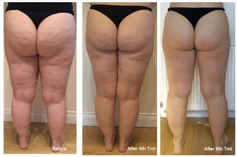 A client's legs and bottom from behind: before, after session four and after session eight of the LipoFirm butt lift and tone