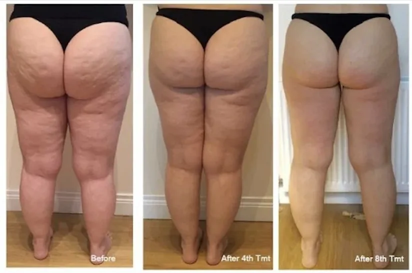 A client's legs and bottom from behind: before, after session four and after session eight of the LipoFirm butt lift and tone