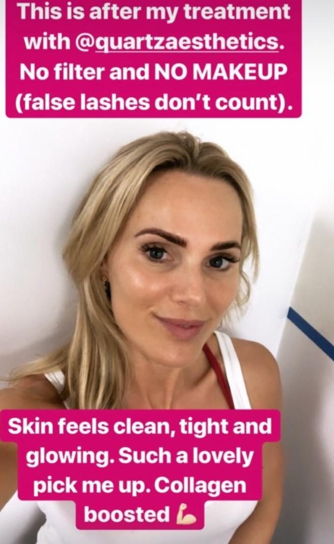 A client posting after her Geneo Superfacial with Quartz Aesthetics