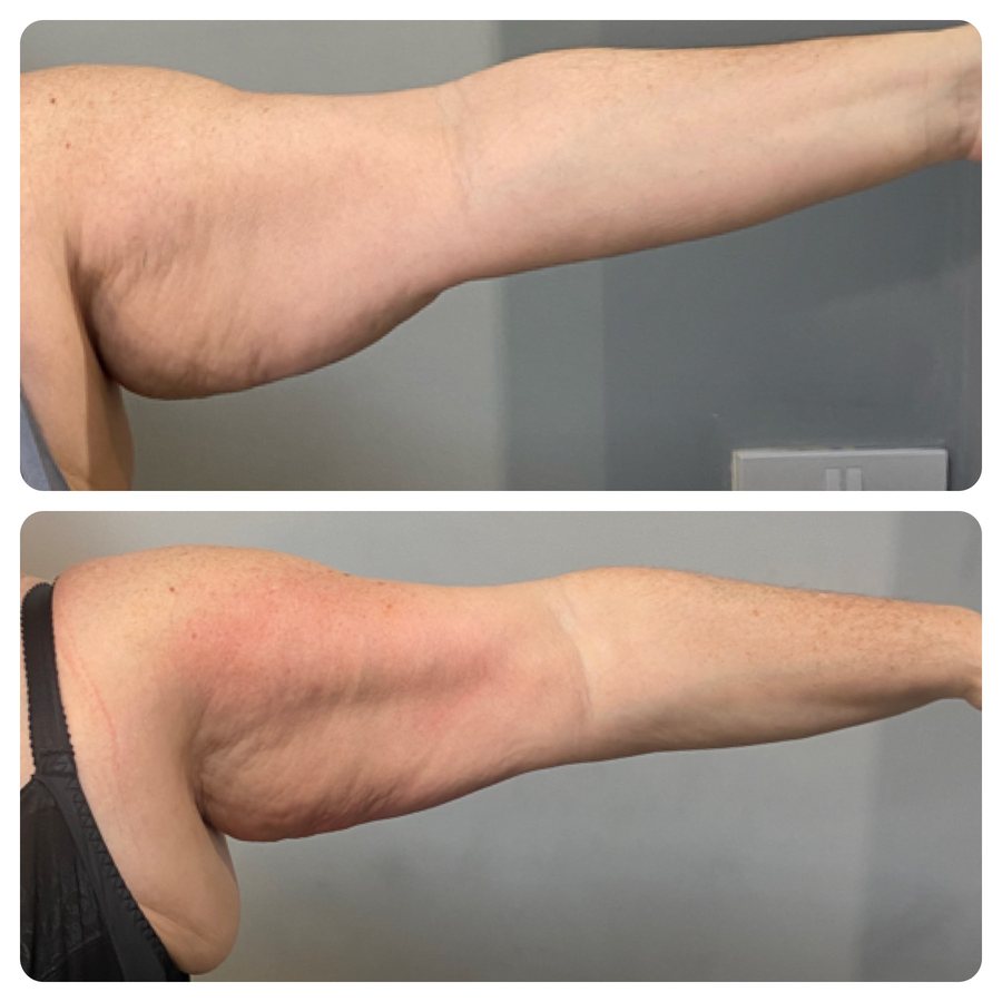 A client of Quartz Aesthetics: the upper arm photographed before and after a course of 8 LipoFirm treatments