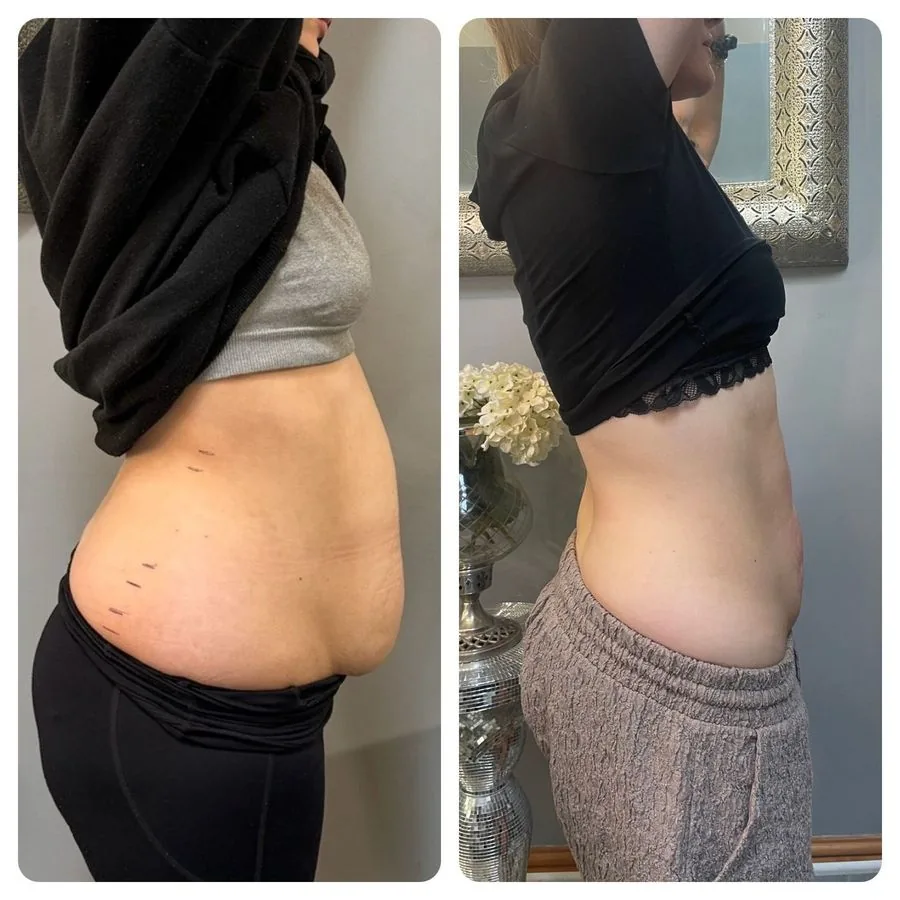 Side view of a client's tummy before and after LipoFirm body contouring