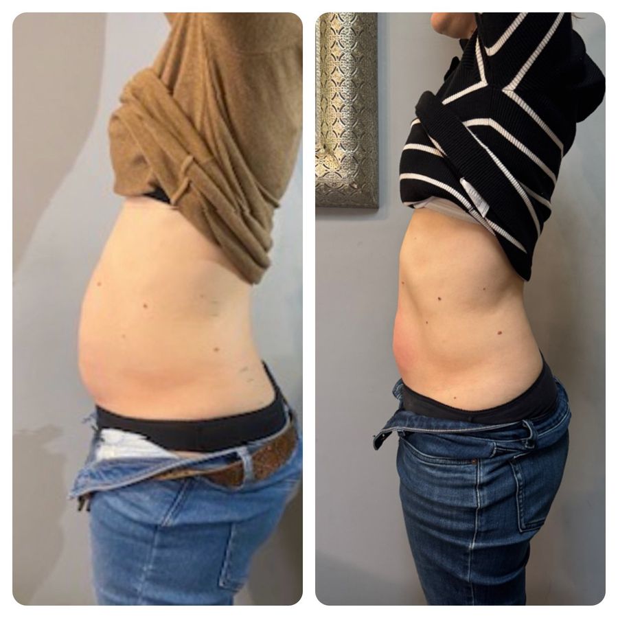 Side view of a client's waist and tummy before and after LipoFirm body contouring