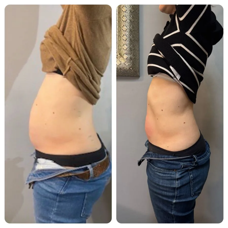 Side view of a client's waist and tummy before and after LipoFirm body contouring