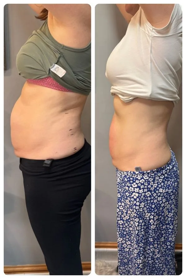 Side view of a client's lower tummy before and after LipoFirm body contouring