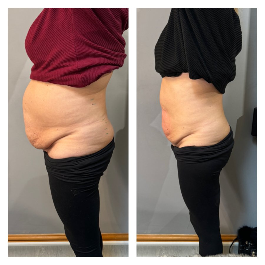 A client of Quartz Aesthetics photographed from the side before and after a course of 8 LipoFirm treatments on the abdomen